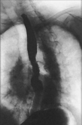 Fig. 12.91 Esofag în LAO—evidențiind zona îngustată a