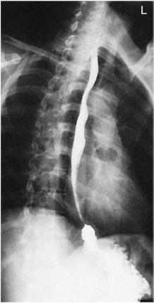 Fig. 12.84 Esofag în RAO.
