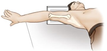 Fig. 5.46 Inferosuperior axial (Metoda Lawrence) incidență.