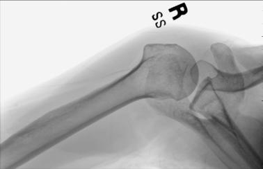 Fig. 5.48 Inferosuperior axial incidență.