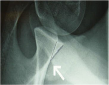 Fig. 5.53 PA axial transaxillary incidență (modified Bernageau).