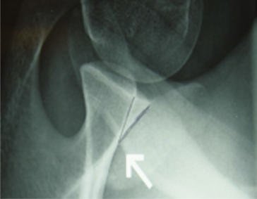 Fig. 5.54 PA axial transaxillary incidență (modified Bernageau).