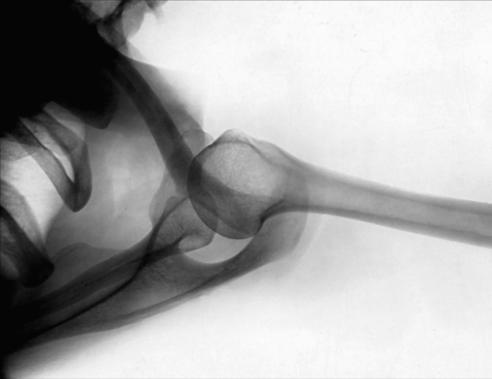 Fig. 5.56 Superoinferior transaxillary.