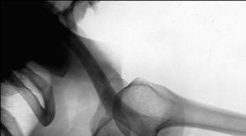 Fig. 5.57 Superoinferior transaxillary.