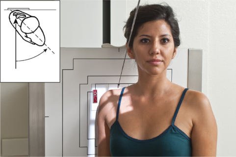 Fig. 5.85 Ortostatism apical oblic axial incidență—45° posterior oblic,