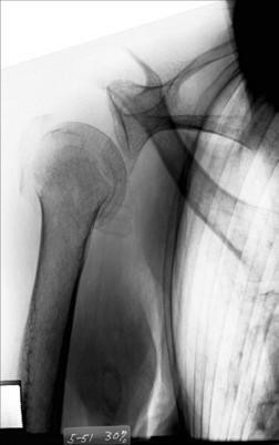 Fig. 5.86 AP apical oblic