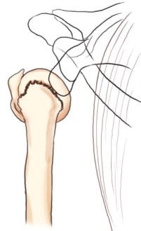 Fig. 5.87 AP apical oblic