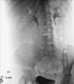 Fig. 14.78 LPO IVU.