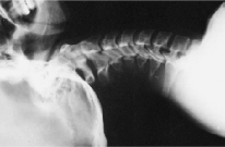 Fig. 8.78 AP axială (pilieri). (Cu amabilitatea Teresei Easton-