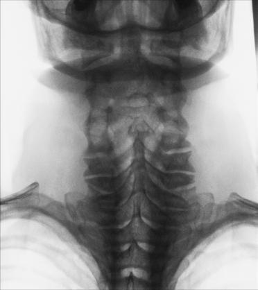 Fig. 8.79 AP axială (pilieri).