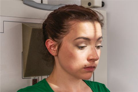 Fig. 11.149 AP axial—zygomatic arches—raza centrală 30° la linie orbitomeatală (LOM) (37° la