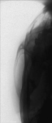 Fig. 11.147 oblic inferosuperior (tangențial).