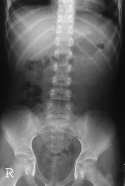 radiographic abnormality este unlikely la fie evidențiat în the