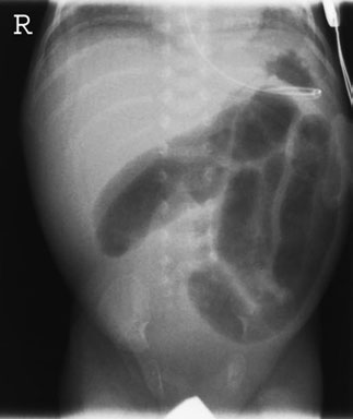 • Optimization de abdominal radiografii includes using lower-