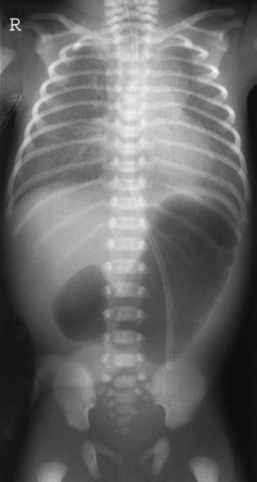 • radiografii de renal tract poate fie more collimated
