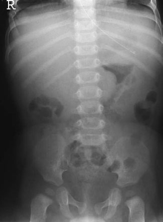 • Abdominal ultrasound has replaced radiografie în many