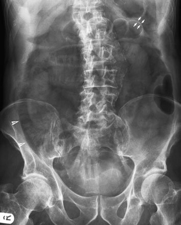 pe radiografia anteroposterioară (AP) convențională. În exemplu