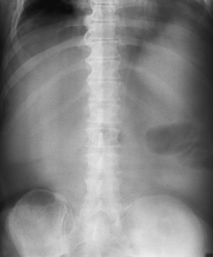 • Tăierea fasciculului de către grilă, asociată radiografiei pe targă sau în salon, poate