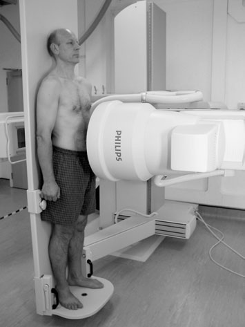 Radiografie anteroposterioară (AP) a abdomenului în ortostatism care evidențiază anse intestinale dilatate