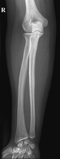 Normal Antero-posterior (AP) radiografie de Antebraț (Radius și Ulna)