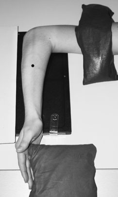 ring, suspiciune de fractură de one de bones este often associated cu frac-