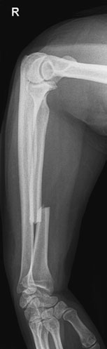ulna, while în Monteggia suspiciune de fractură there este suspiciune de fractură de ulna