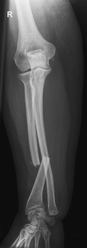 Normal basic Profil (lateral) radiografie de Antebraț (Radius și Ulna)