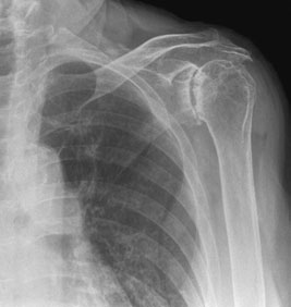 Umăr evidențiind severe arthritic