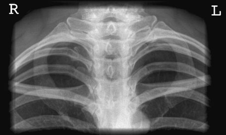 radiografie de normal Articulații Sternoclaviculare în Postero-anterior (PA) incidență