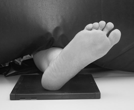 radiografie evidențiind effect de 20-grade
