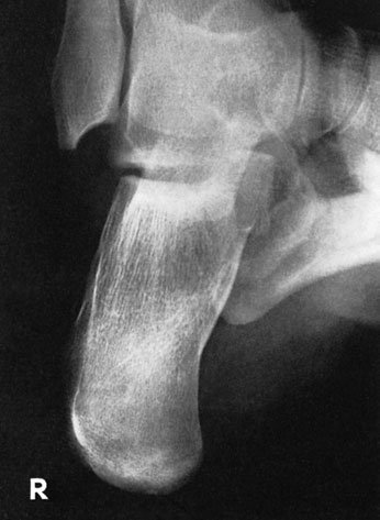 radiografie evidențiind effect de 10-grade