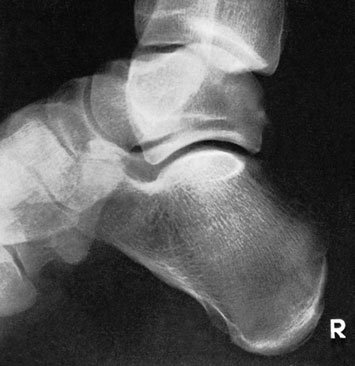 Figura 3: Aspect radiografic / Poziționare (Clark Ed. 12)