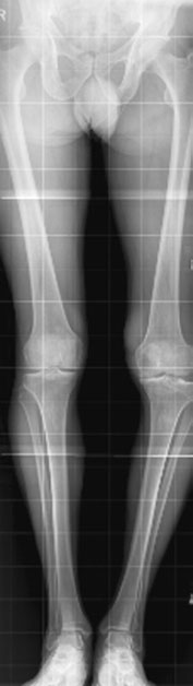 Digital computed radiografie
