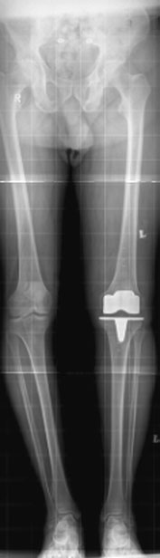 poziție la allow Fascicul Orizontal radiografie using large FFD,