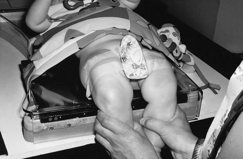 imagine de Antero-posterior (AP) Bazin (bazin (pelvis)) evidențiind window gonad protection cu