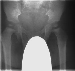 • Șold radiografii sunt common request în children, but initial