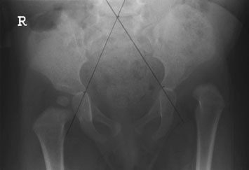 use de this line în straight Antero-posterior (AP) radiografie de the