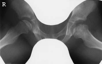 imagine de Antero-posterior (AP) și turned Profil (lateral) de stâng Șold evidențiind stâng femoral
