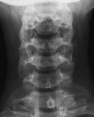 și pentru a aduce linia de bază radiografică la un unghi de 20