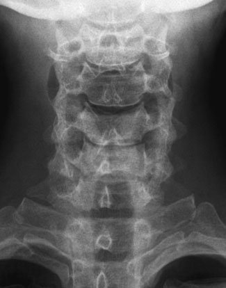 Radiografie antero-posterioară (AP) care evidențiază laringele normal.