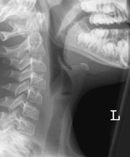 Radiografie de profil care evidențiază suspiciune de fractură a osului hioid.