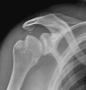 angulation la show calcificări patologice