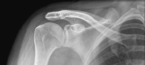 Antero-posterior (AP) Decubit dorsal radiografie de Claviculă evidențiind suspiciune de fractură