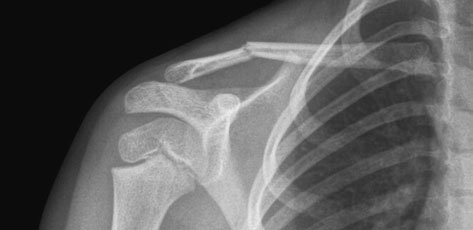 Antero-posterior (AP) Decubit dorsal radiografie de Claviculă evidențiind pathological suspiciune de fractură