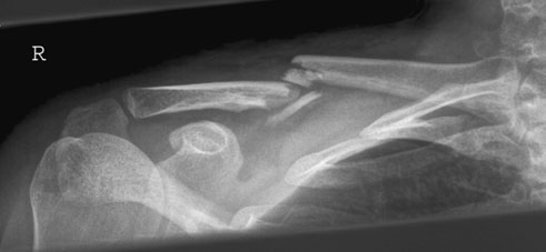 subclavian vessel damage sau pneumotorax.