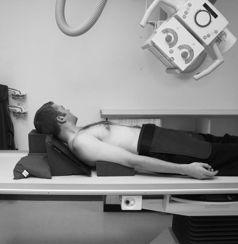 Decubit dorsal Infero-Superioară (Axială) radiografie de Claviculă evidențiind early healing de a