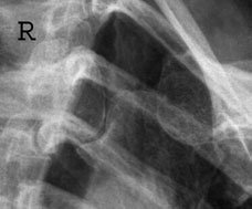 Axială diagram evidențiind incidență pentru drept articulații sternoclaviculare