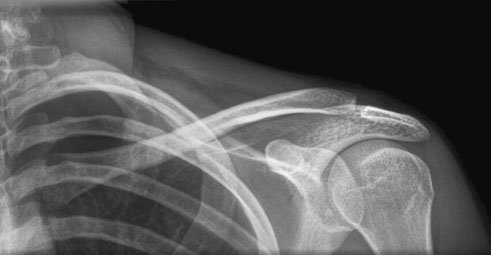 Normal Postero-anterior (PA) radiografie de Claviculă