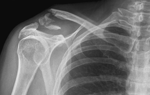 Postero-anterior (PA) radiografie de Claviculă evidențiind comminuted suspiciune de fractură