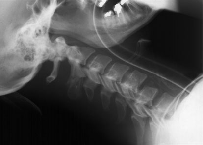 la stabilirea acestui diagnostic la copii, la care spațiul normal